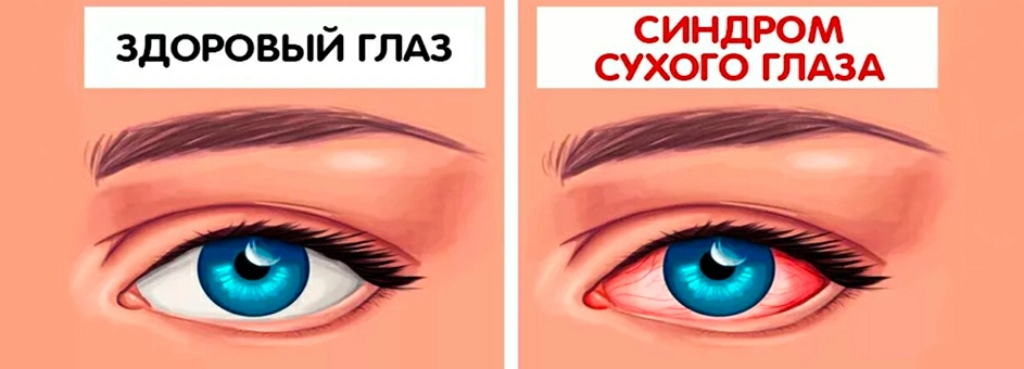 Глазки сухо